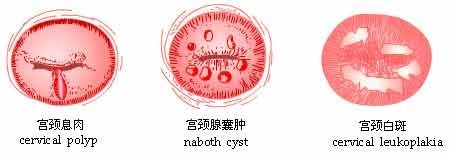 宫颈白斑的症状
